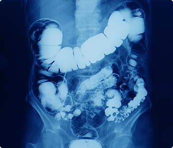 Bowel Paralysis.